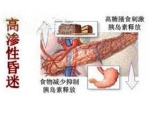 2型糖尿病性高渗性昏迷