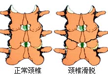 颈椎滑脱