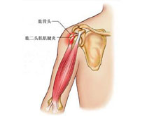 肌腱炎