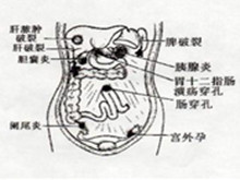 原发性腹膜炎