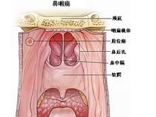 鼻咽癌