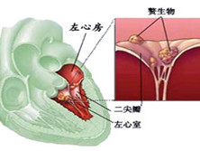 小儿感染性心内膜炎