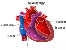 先天性冠状动脉瘤