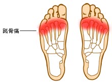 跖骨痛