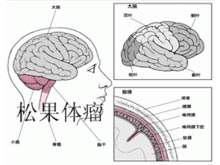 松果体细胞瘤