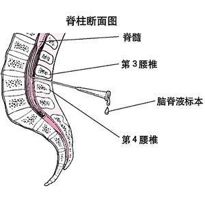 急性脊髓炎