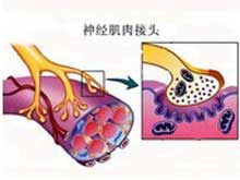 吉兰-巴雷综合征