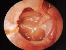 粘连性中耳炎
