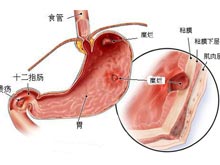 十二指肠溃疡