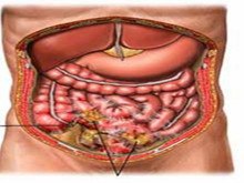 急性腹膜炎