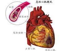 心肌梗死