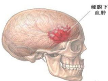 亚急性硬膜外血肿