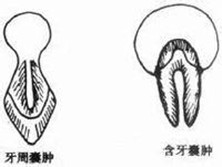 含牙囊肿