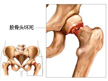 股骨头坏死