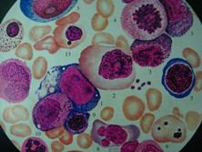 巨幼细胞性贫血