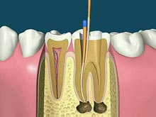 根管治疗