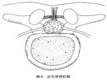 移行脊椎