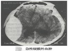 急性和亚急性硬脑膜下血肿