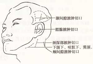 眶下间隙感染