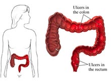溃疡性结肠炎