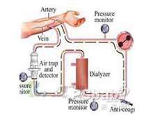 透析失衡综合征