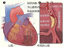 急性心肌梗死