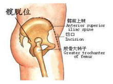 髋关节脱位