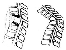 脊椎结核并发截瘫