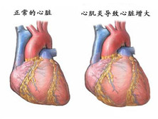 特异性心肌病