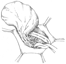 复发性腹股沟疝