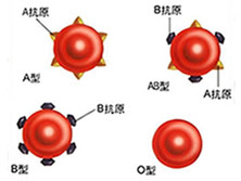 母儿ABO血型不合