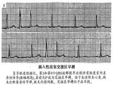 房室交接区性期前收缩