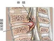 食管压迫型颈椎病