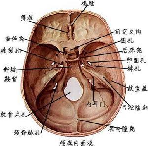 颅中窝脑膜瘤