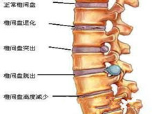 胸椎间盘突出症