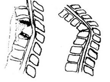 并发截瘫的脊柱结核