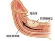 阴茎硬结症