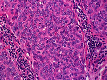 胸腺小细胞癌