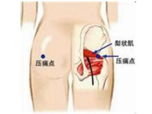 梨状肌综合征