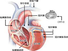 戈登综合征