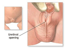 小儿尿道下裂