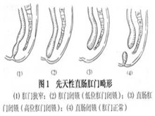 新生儿肛门和直肠畸形