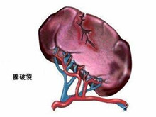 小儿脾外伤