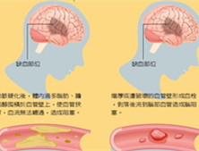 脑中风