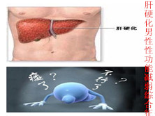 肝硬化男性性功能减弱综合征