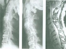 下颈椎不稳症
