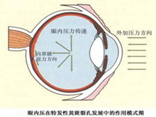 特发性黄斑裂孔