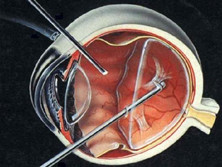 脉络膜视网膜炎
