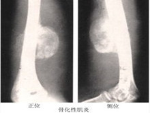 小儿进行性骨化性肌炎