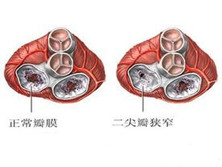 先天性二尖瓣狭窄